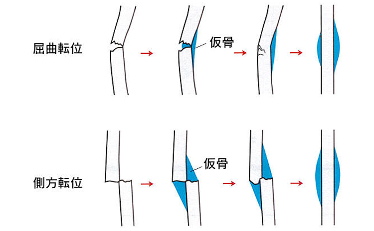 屈曲転位 側方転位