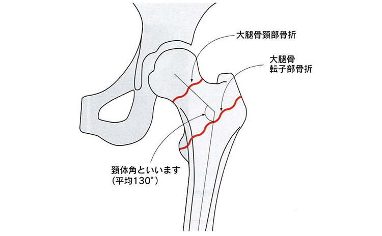 大腿（だいたい）骨頚部（けいぶ）骨折　大腿（だいたい）骨転子部骨折 頚体角といいます(平均130°)