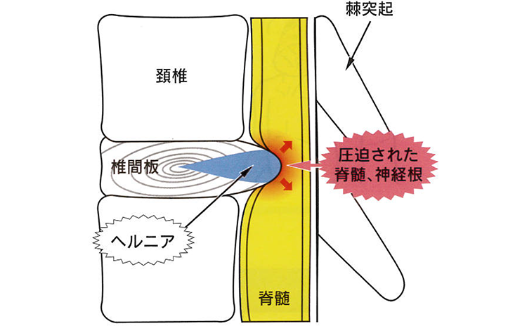 頚椎(けいつい)椎間板ヘルニア:病態