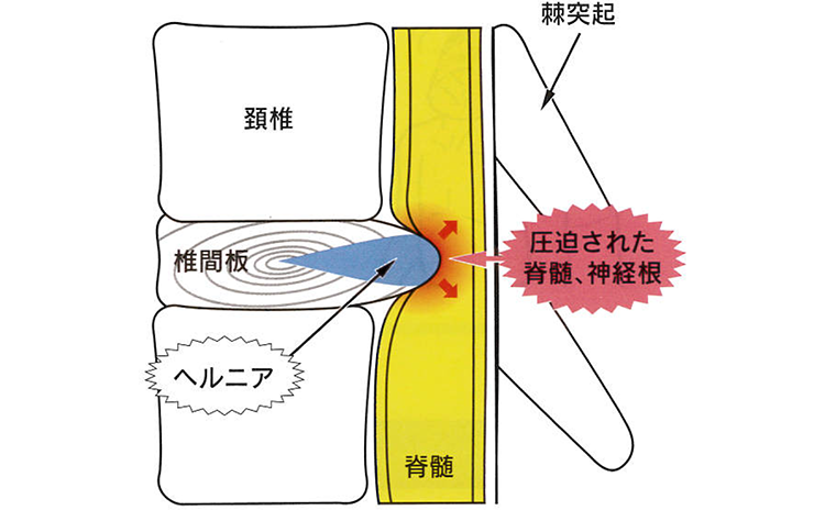 頚椎（けいつい）椎間板ヘルニア：病態