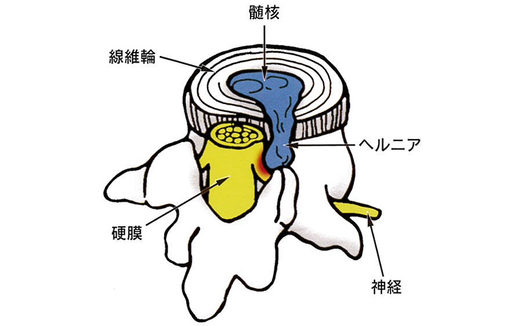 髄核 繊維輪 硬膜 ヘルニア 神経