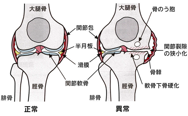 関節軟骨の正常時と異常時の比較図