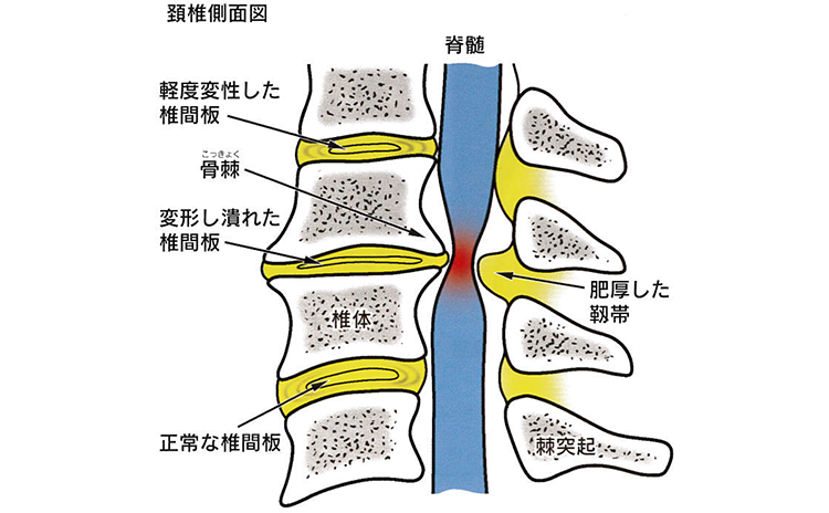 原因・病態：脊髄症