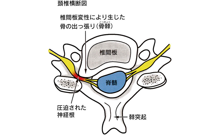 原因・病態：神経根症