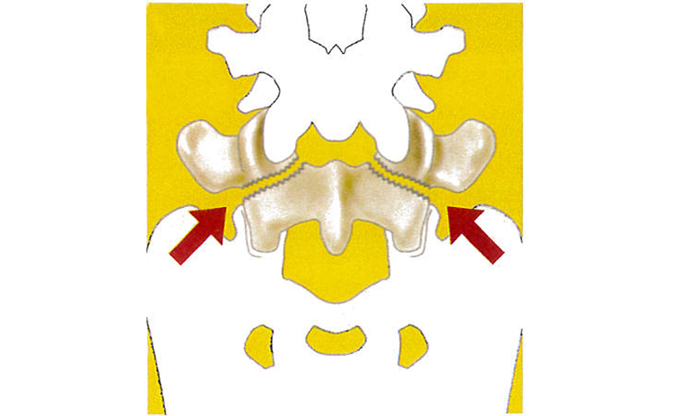 腰椎分離症：原因・病態2